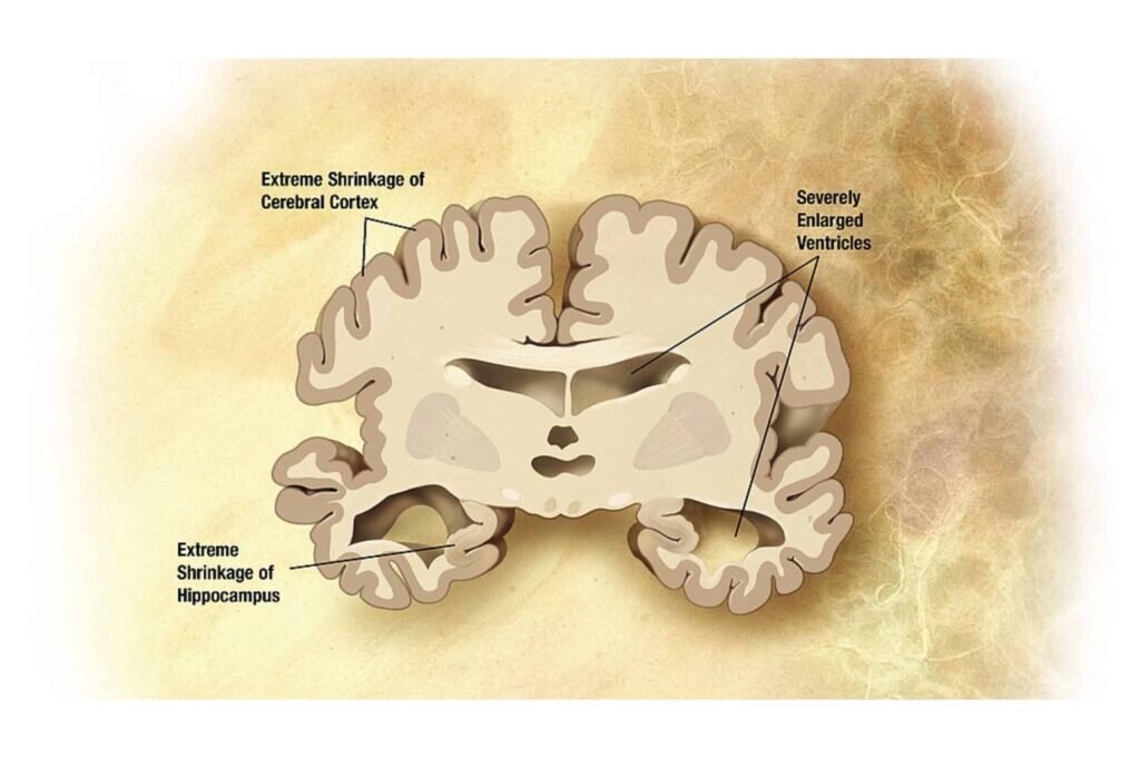 Late stage Alzheimers brain illustration.
