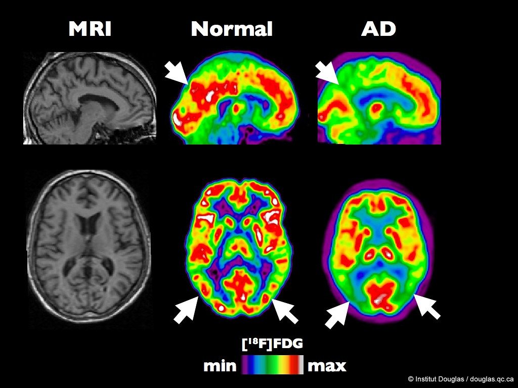 A healthy brain compared to a brain at an early stage of Alzheimers disease. 