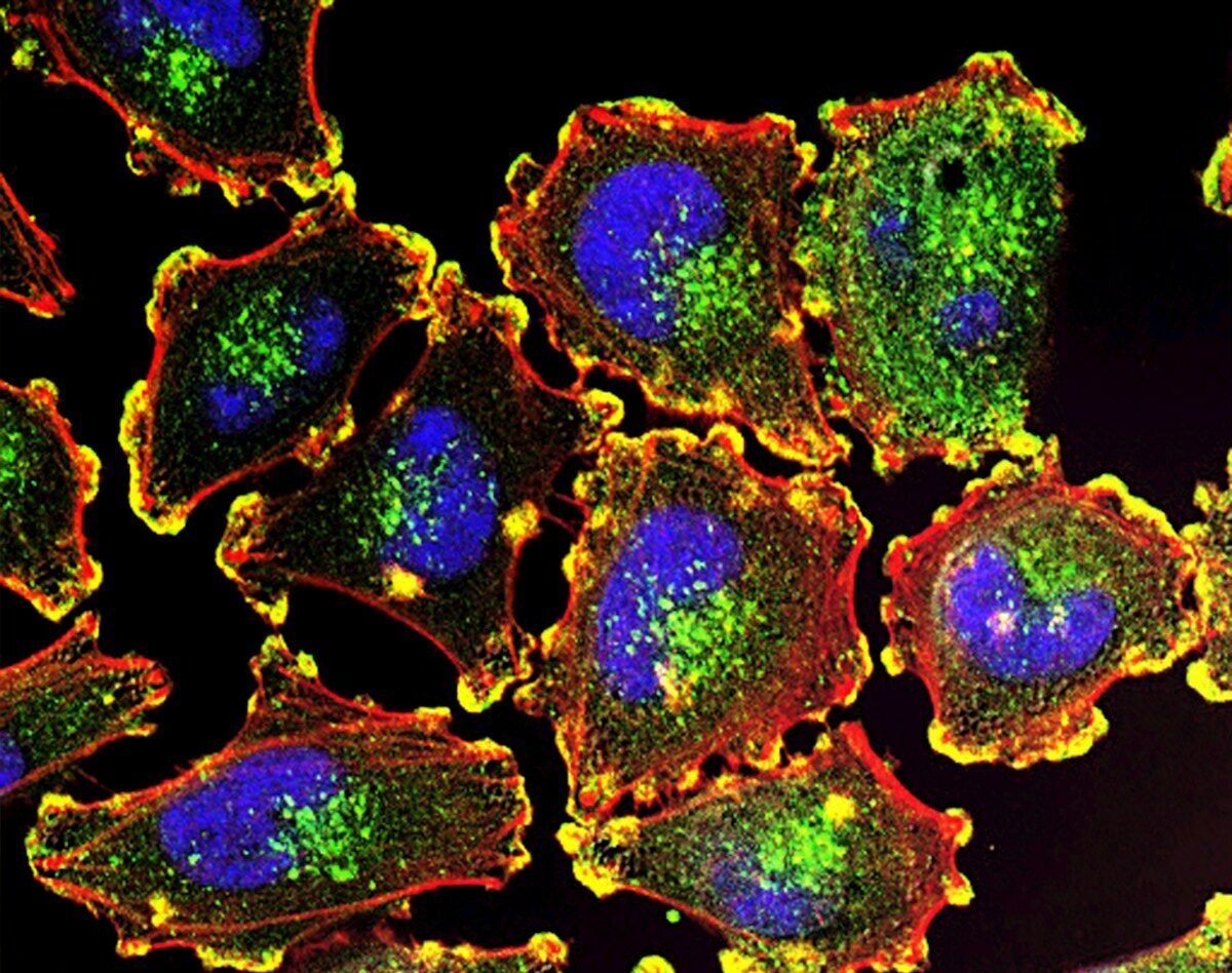 Microscopic view metastatic melanoma cells.