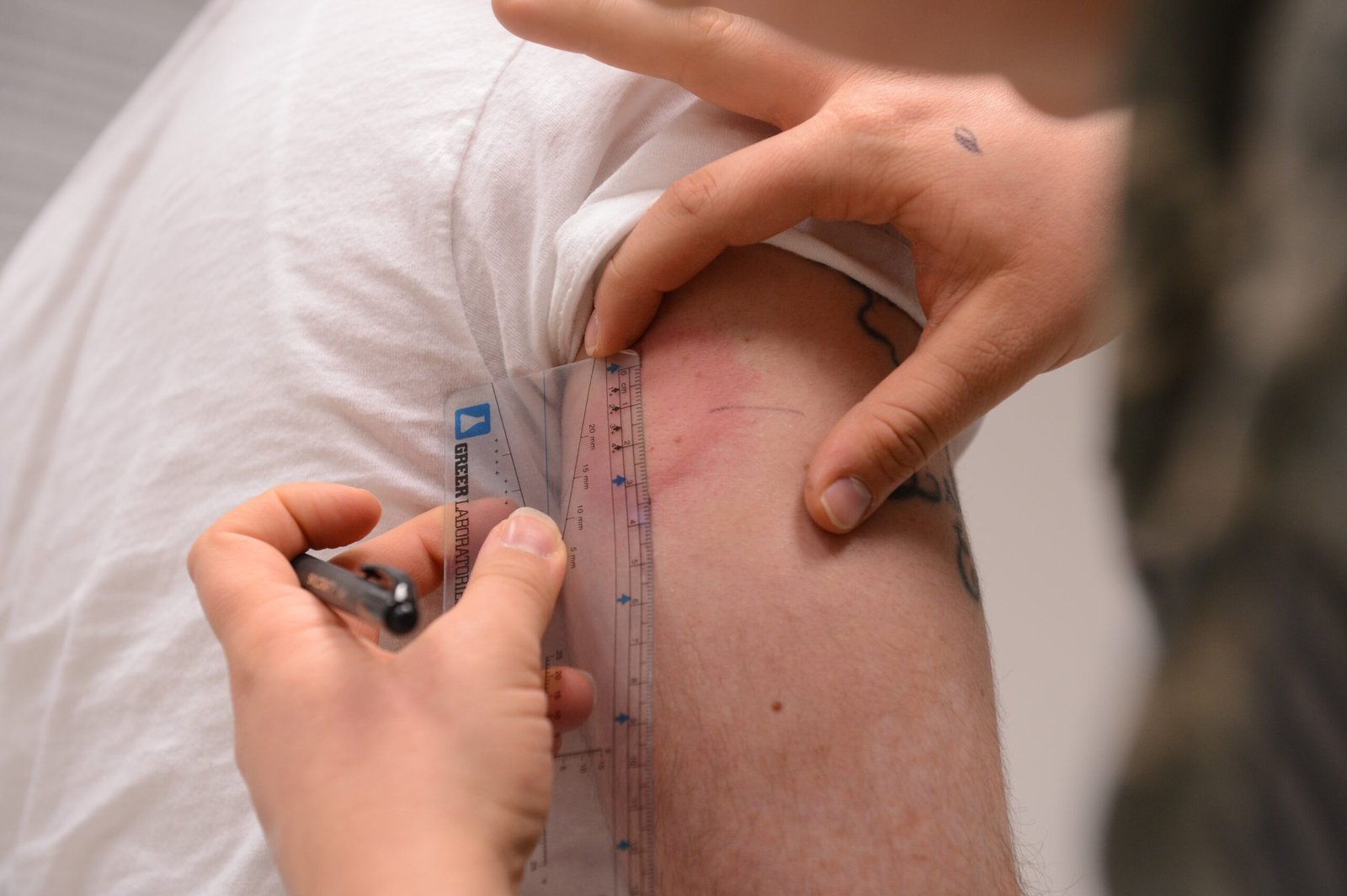 Recognizing and Responding to Allergic Reactions (image credits: wikimedia)