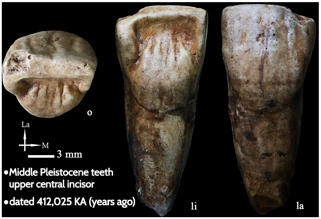 Challenges in Interpreting Dental Evidence (image credits: wikimedia)