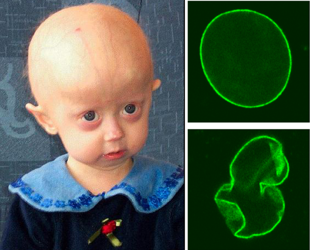 Progeria in a child.