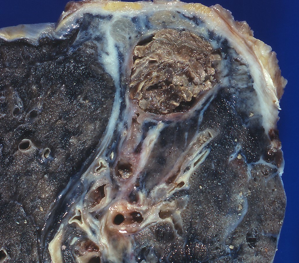 How Does a Fungus Invade the Lungs? (image credits: wikimedia)