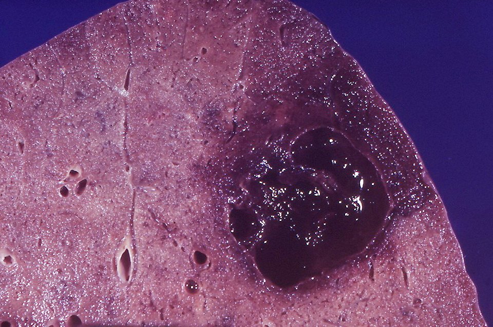 Different Faces of Aspergillus Infection (image credits: wikimedia)