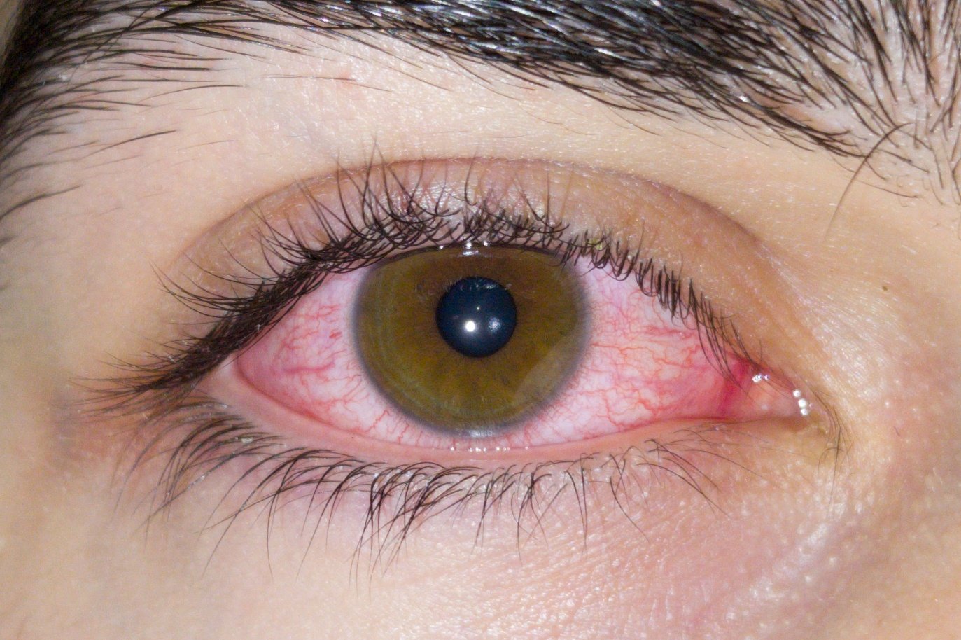 The Horrifying Reality of Acanthamoeba Keratitis (image credits: wikimedia)