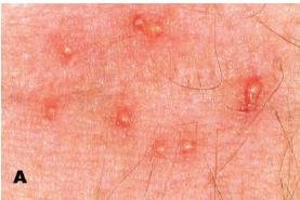 Signs That Mites Are Lurking in Your Mattress (image credits: wikimedia)