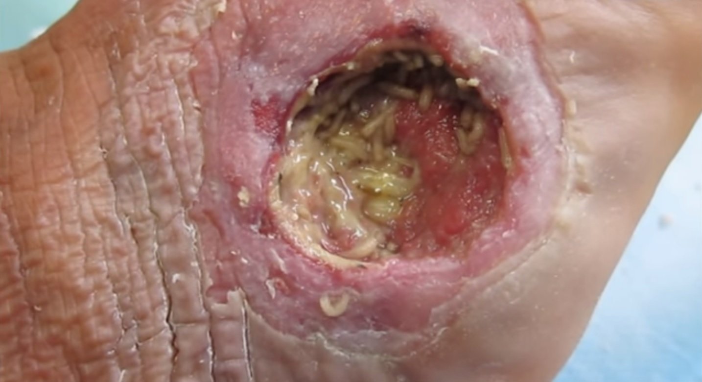How Maggot Therapy Works in Practice (image credits: wikimedia)