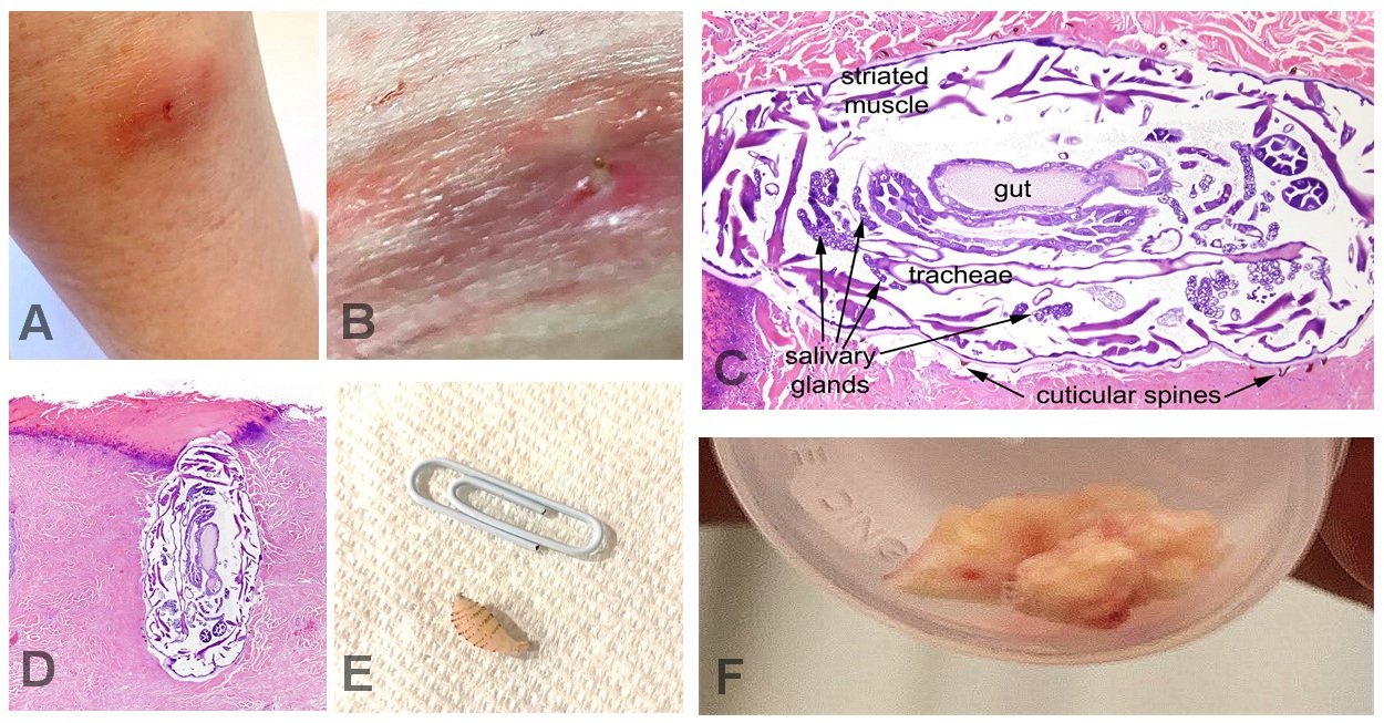 Risks and Complications of Botfly Infestation (image credits: wikimedia)