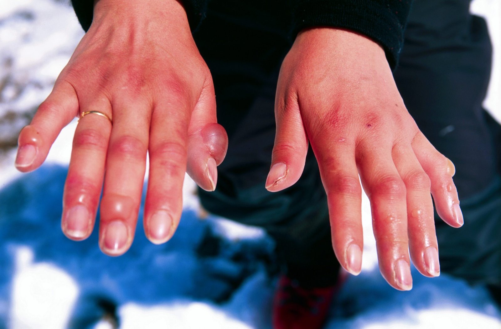 Frostbite: The Cold’s Silent Attack (image credits: wikimedia)