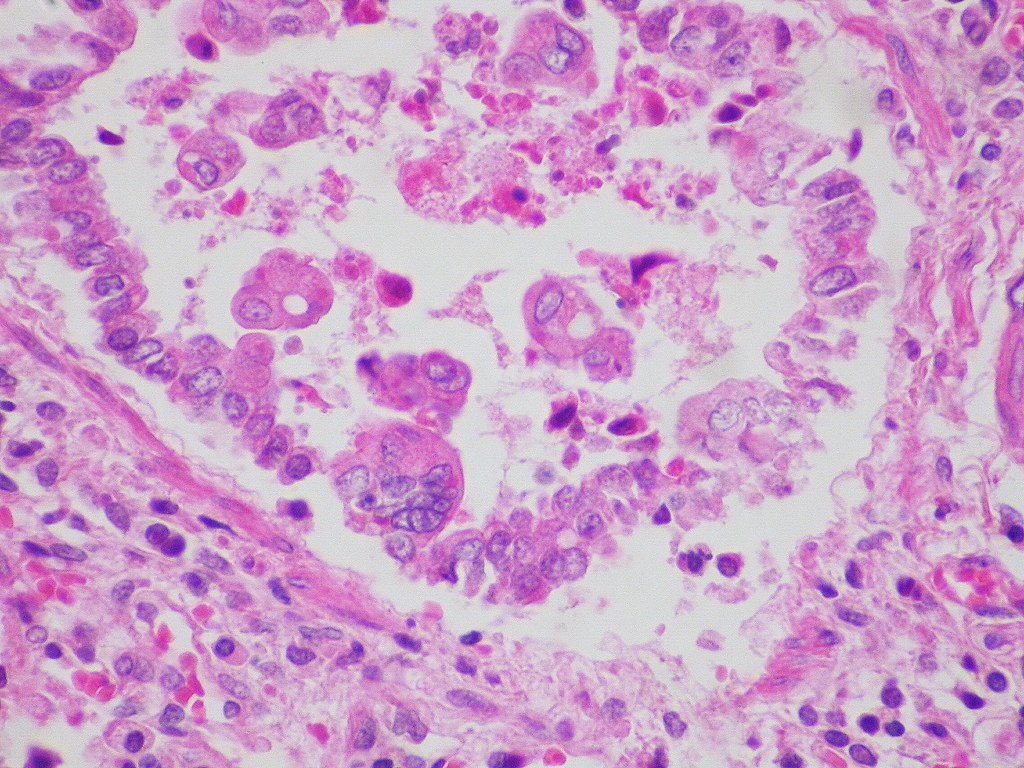 Respiratory syncytial virus (RSV) infection - Case 288