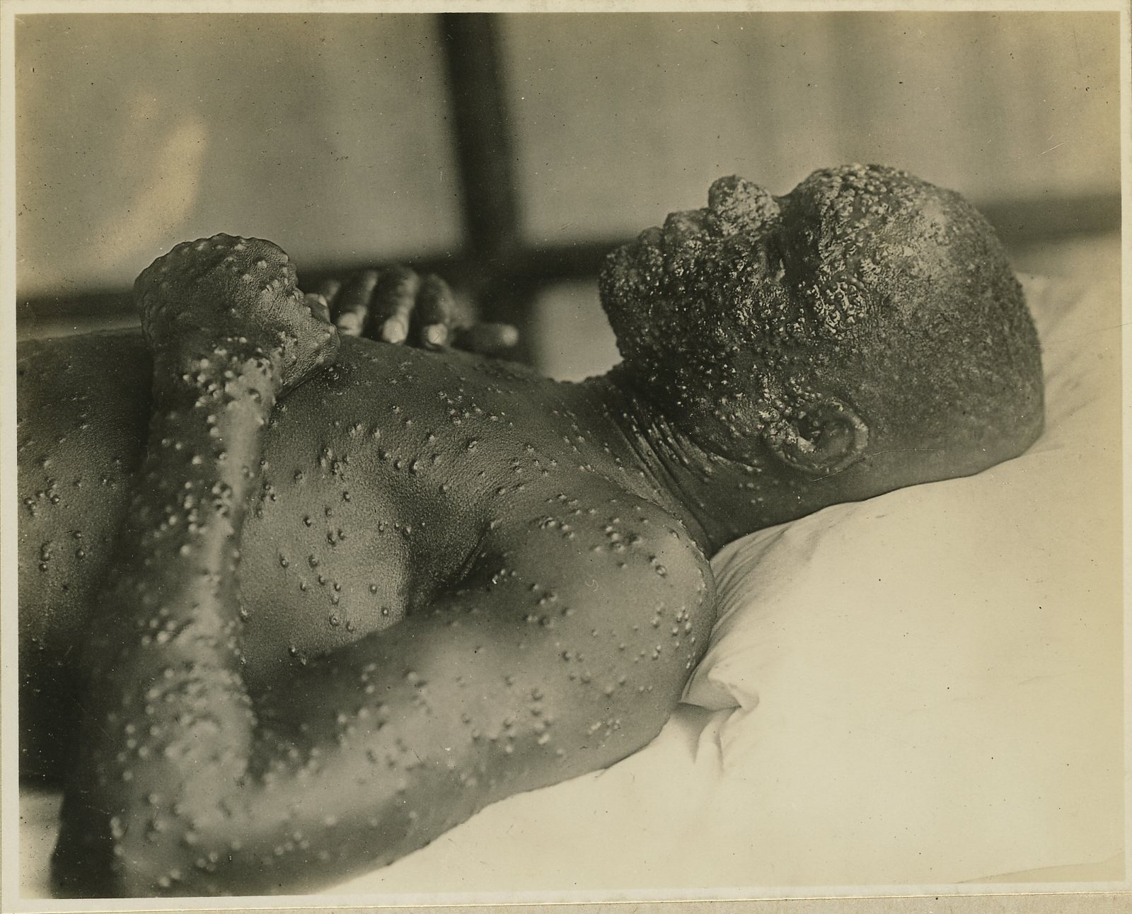 What Made Smallpox So Terrifying? (image credits: wikimedia)