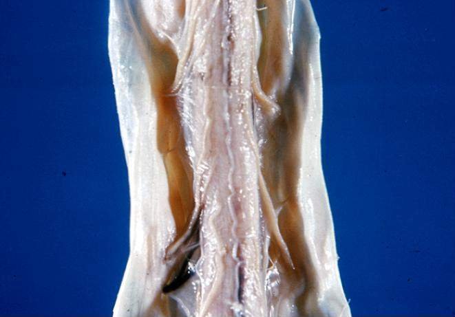 Dehydration and Disc Health (image credits: wikimedia)