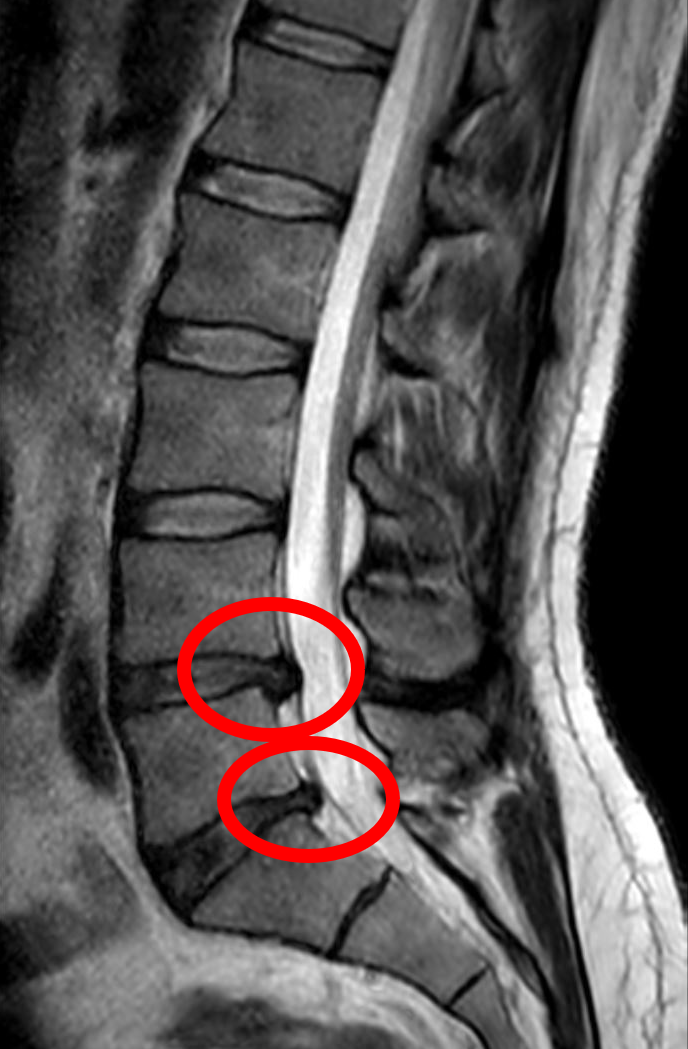 The Science of Spinal Compression (image credits: wikimedia)