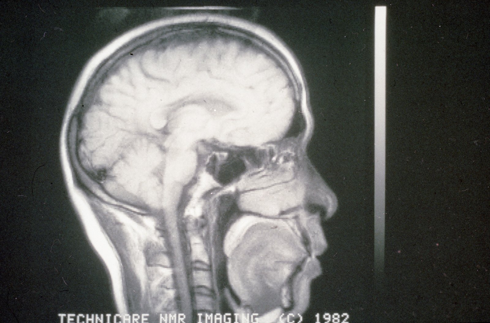 Mapping the Human Mind: The Brain’s Mysteries Unlocked (image credits: wikimedia)