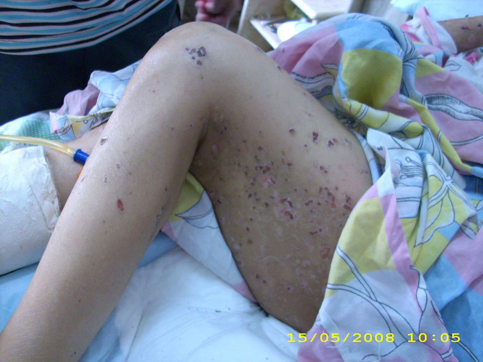 Vitiligo: The Autoimmune Attack on Pigment Cells (image credits: wikimedia)