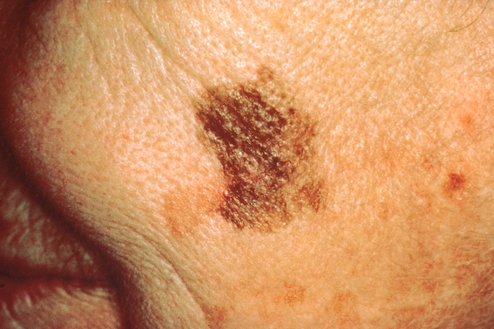 Melanoma: When Skin Cells Turn Dangerous (image credits: wikimedia)