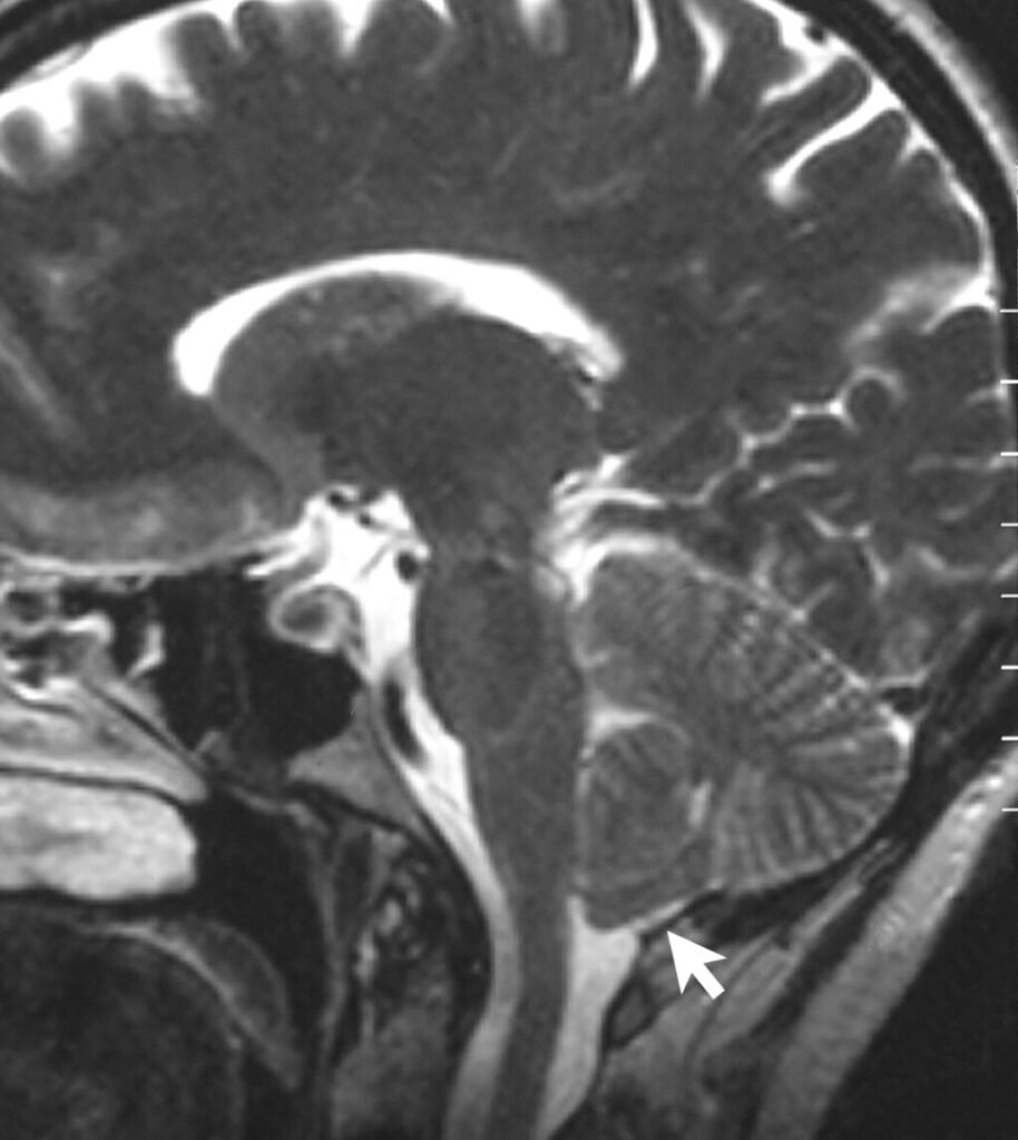 Sagittal MRI scan of brain of patient with Chiari malformation