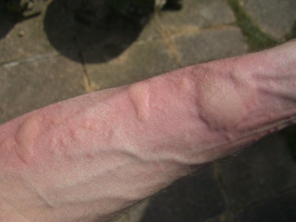 The Silent Invasion: How Infection Begins (image credits: flickr)