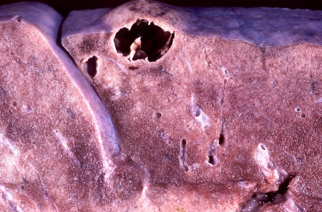 From Bump to Crater: The Progression of Disease (image credits: flickr)