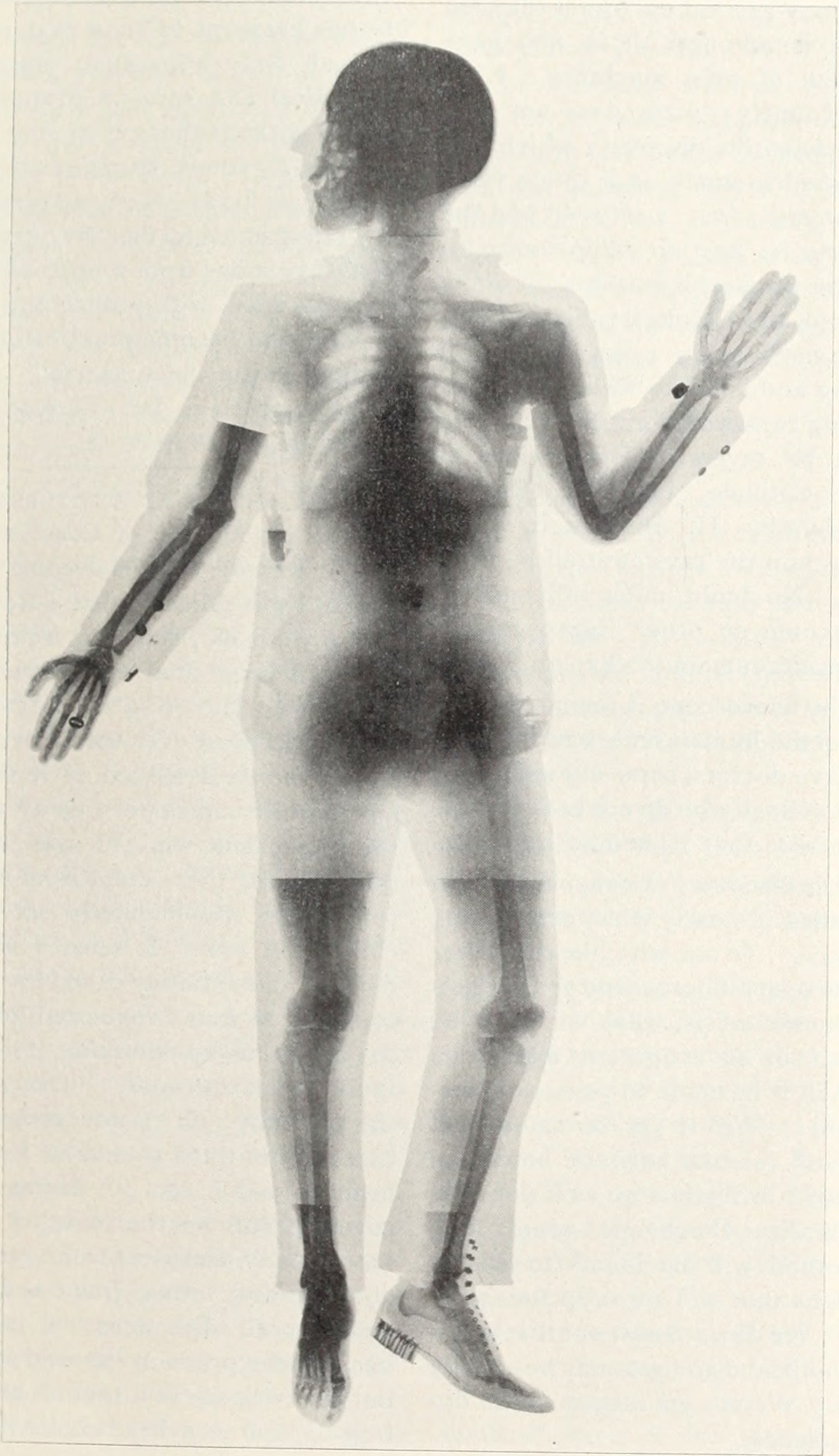 Röntgen's Accidental X-Ray Discovery (image credits: wikimedia)