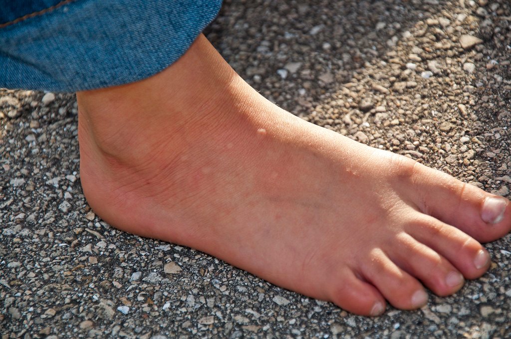 Medical Frontlines: Treating Fire Ant Casualties (image credits: flickr)