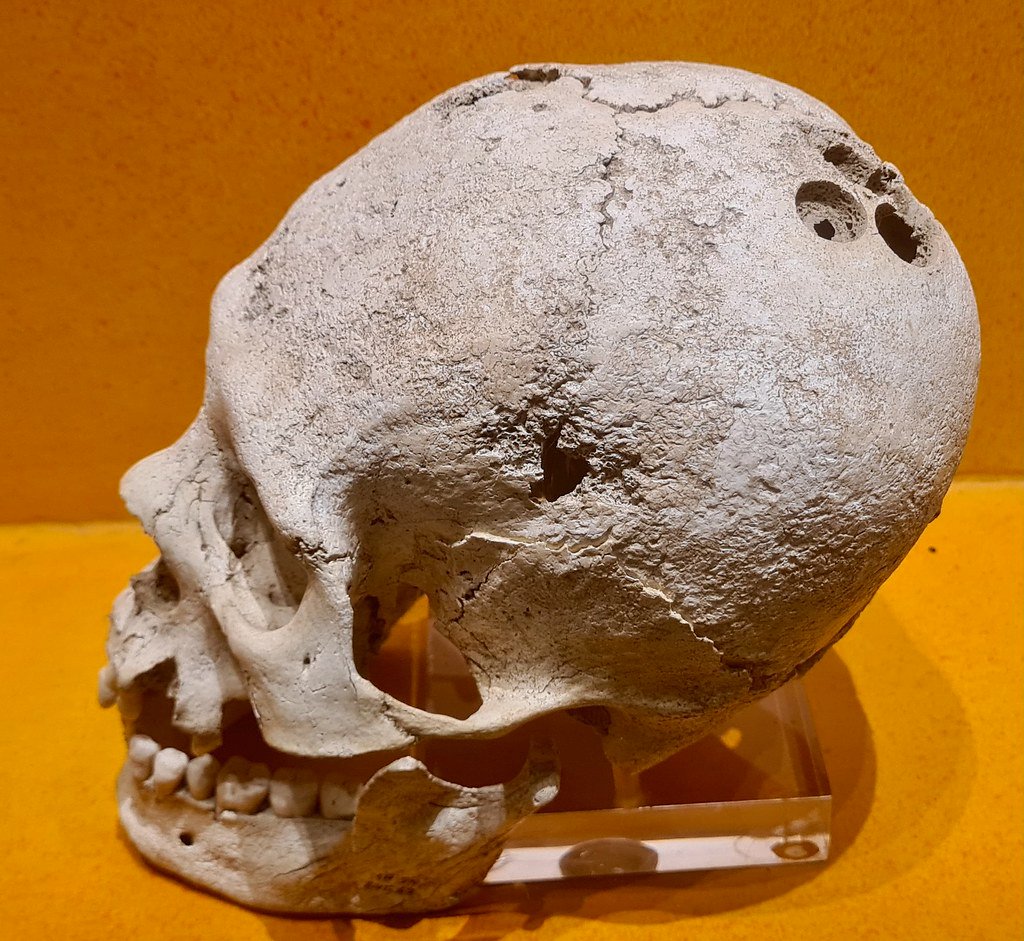 The Mystery of Trepanation Revealed (image credits: flickr)