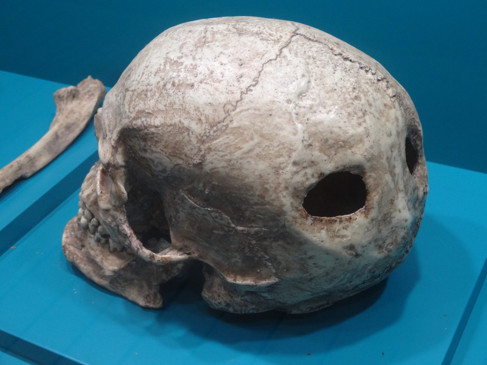 Skulls With Holes: Did Ancient Surgeons Perform Brain Surgery?
