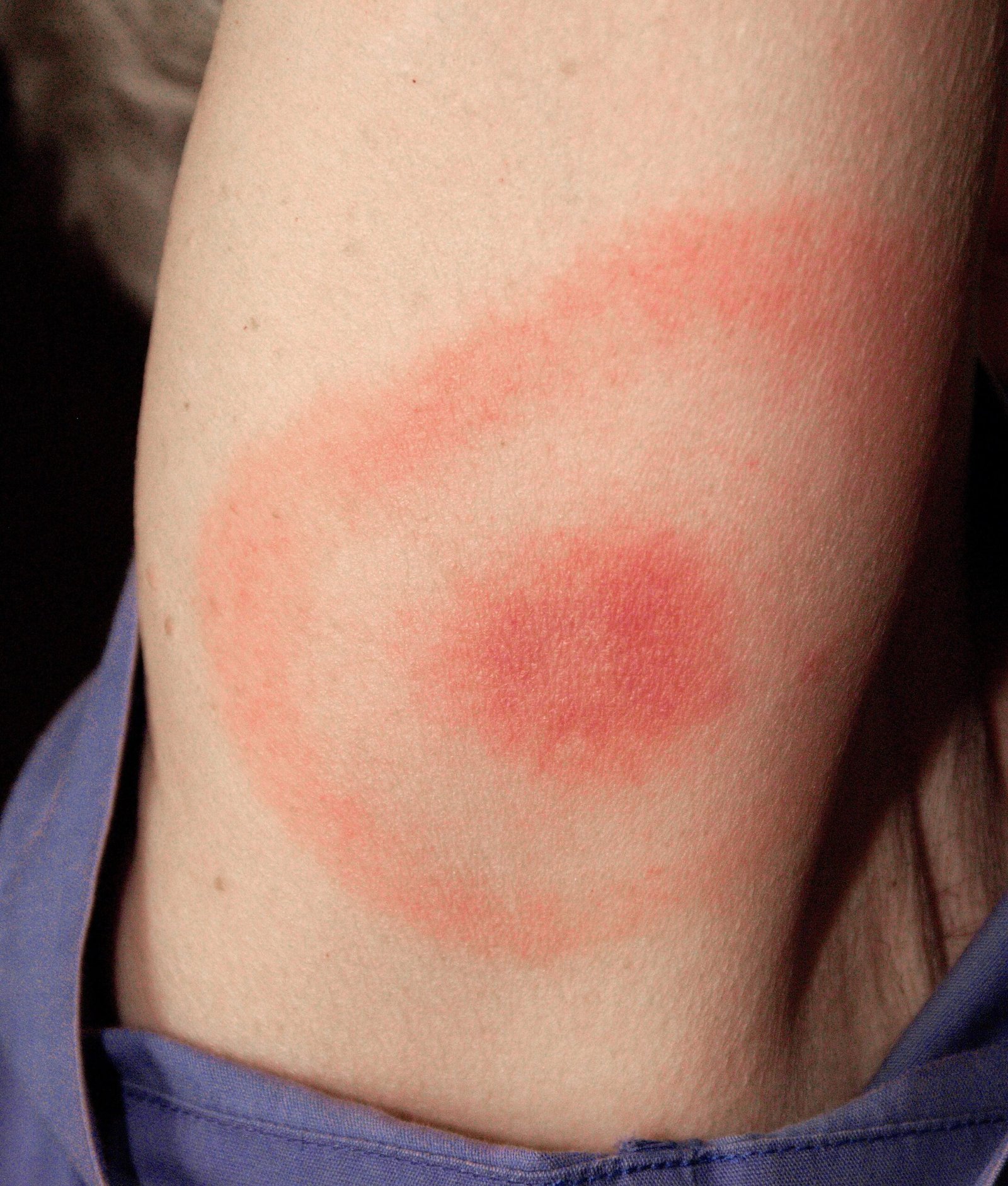 Ehrlichiosis: The Fever That Fools Everyone (image credits: wikimedia)