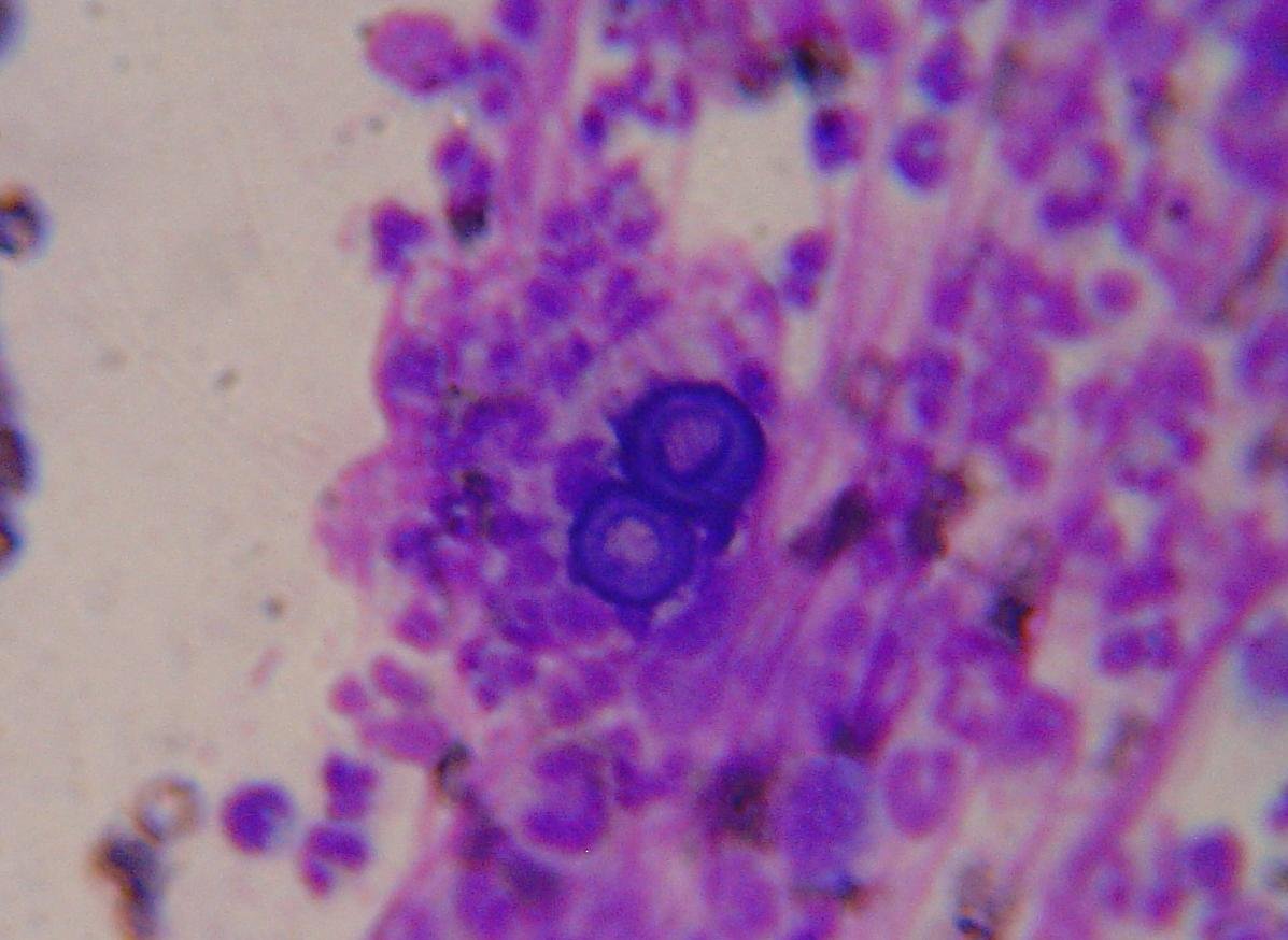 Blastomycosis: Another Hidden Fungal Threat (image credits: By Joel Mills, CC BY-SA 3.0, https://commons.wikimedia.org/w/index.php?curid=927183)