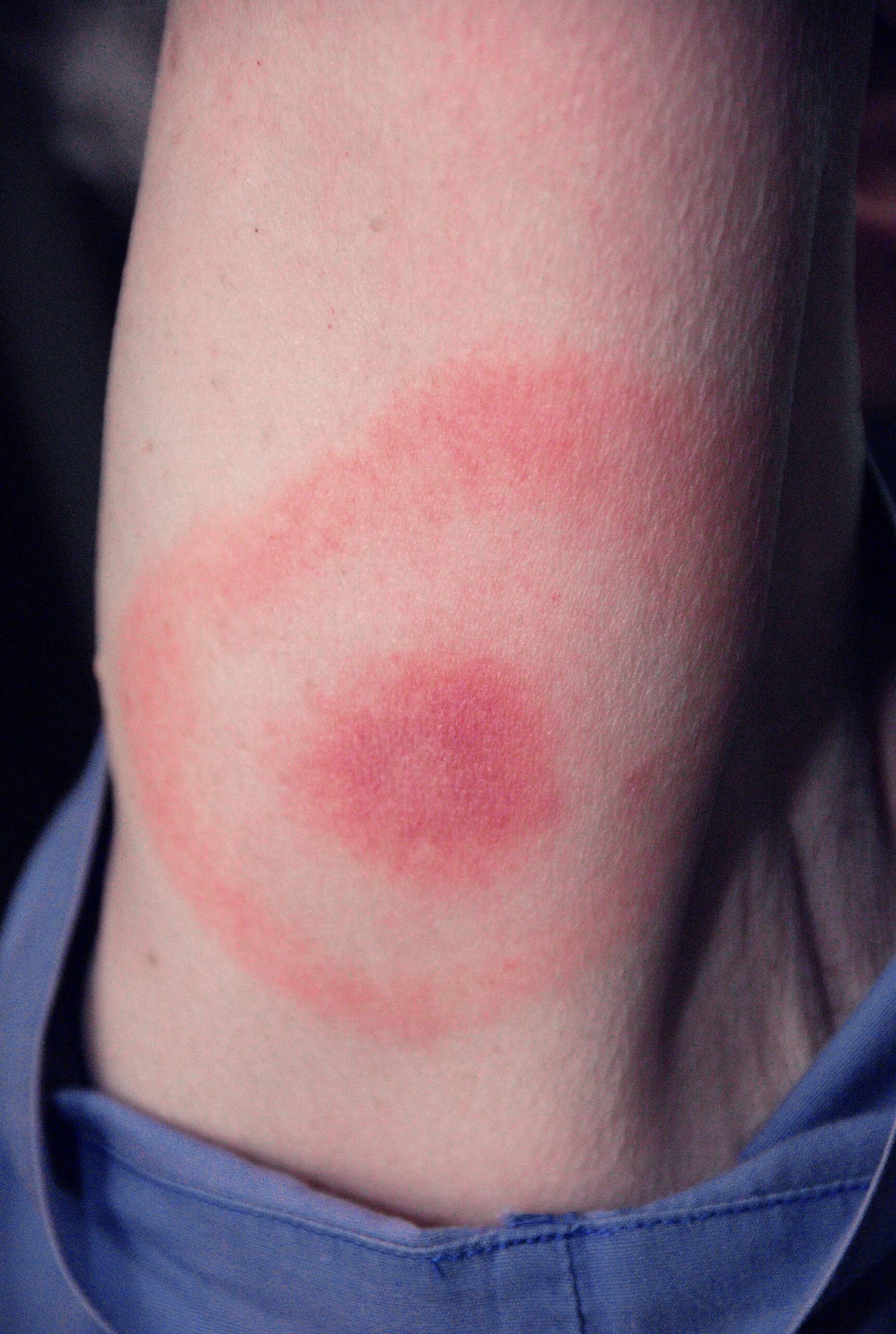 Diseases Beyond Lyme: What They Carry (image credits: wikimedia)