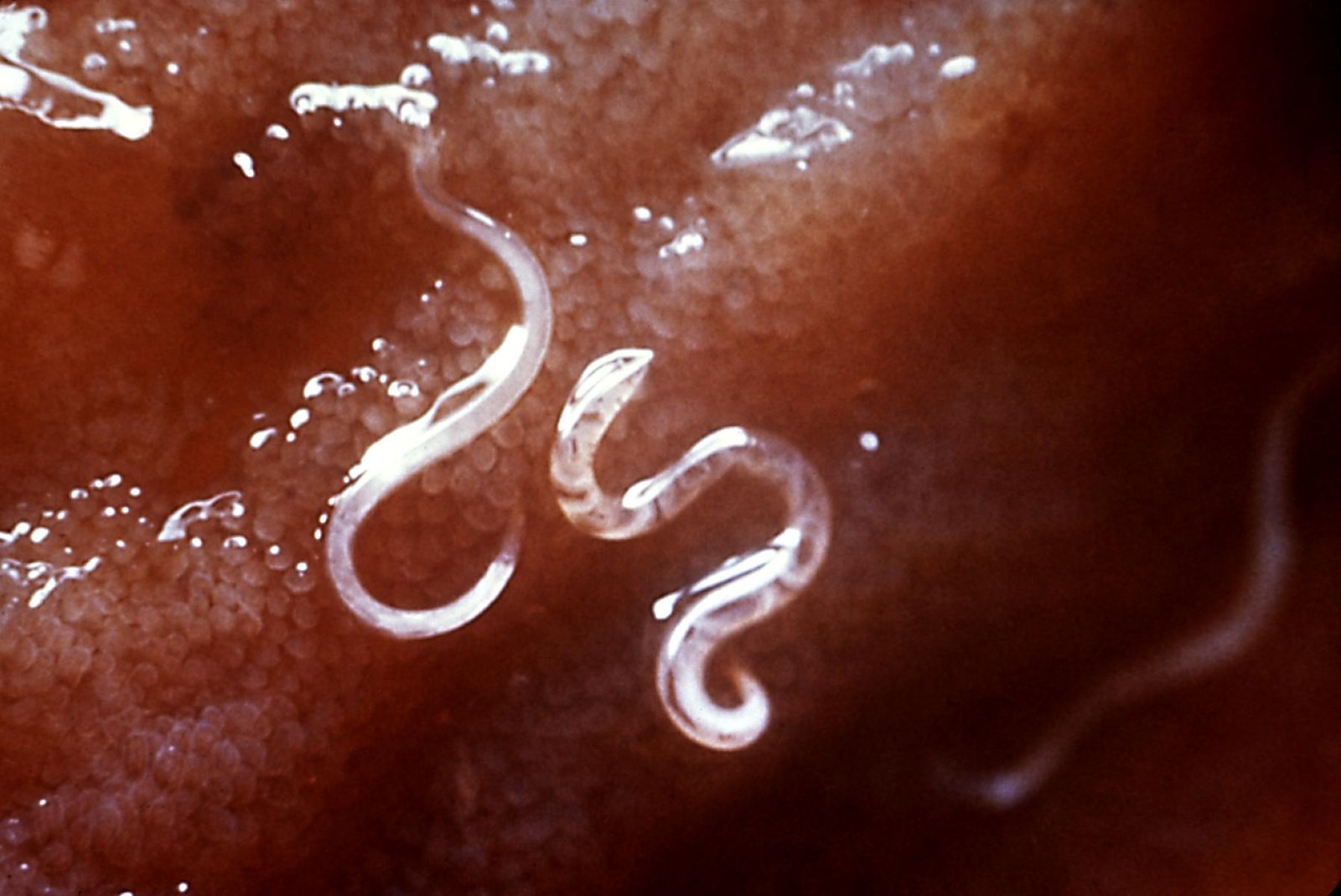 The Shocking Return of Hookworm in America's Poorest Counties (image credits: Transferred from en.wikipedia to Commons.This media comes from the Centers for Disease Control and Prevention's Public Health Image Library (PHIL), with identification number #5205.Note: Not all PHIL images are public domain; be sure to check copyright status and credit authors and content providers.العربية | Deutsch | English | македонски | slovenščina | +/−, Public domain, https://commons.wikimedia.org/w/index.php?curid=1877700)
