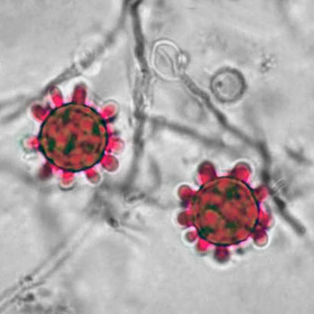Histoplasmosis: The Midwest's Fungal Nightmare