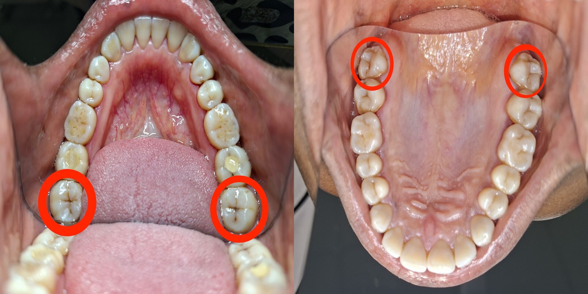 Wisdom Teeth: Obsolete Chewing Tools or Evolution Still in Progress?
