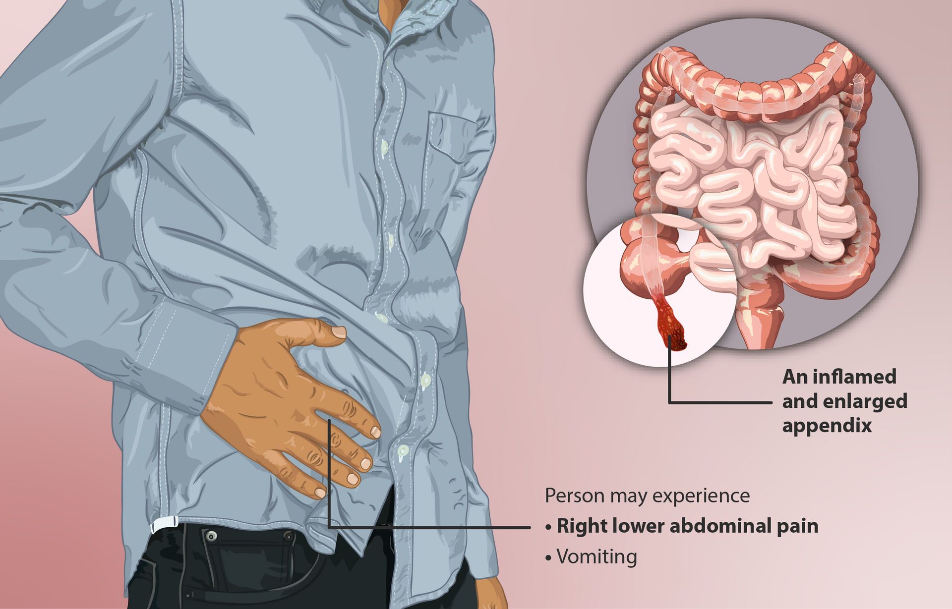 Appendicitis: When a Helpful Organ Turns Dangerous