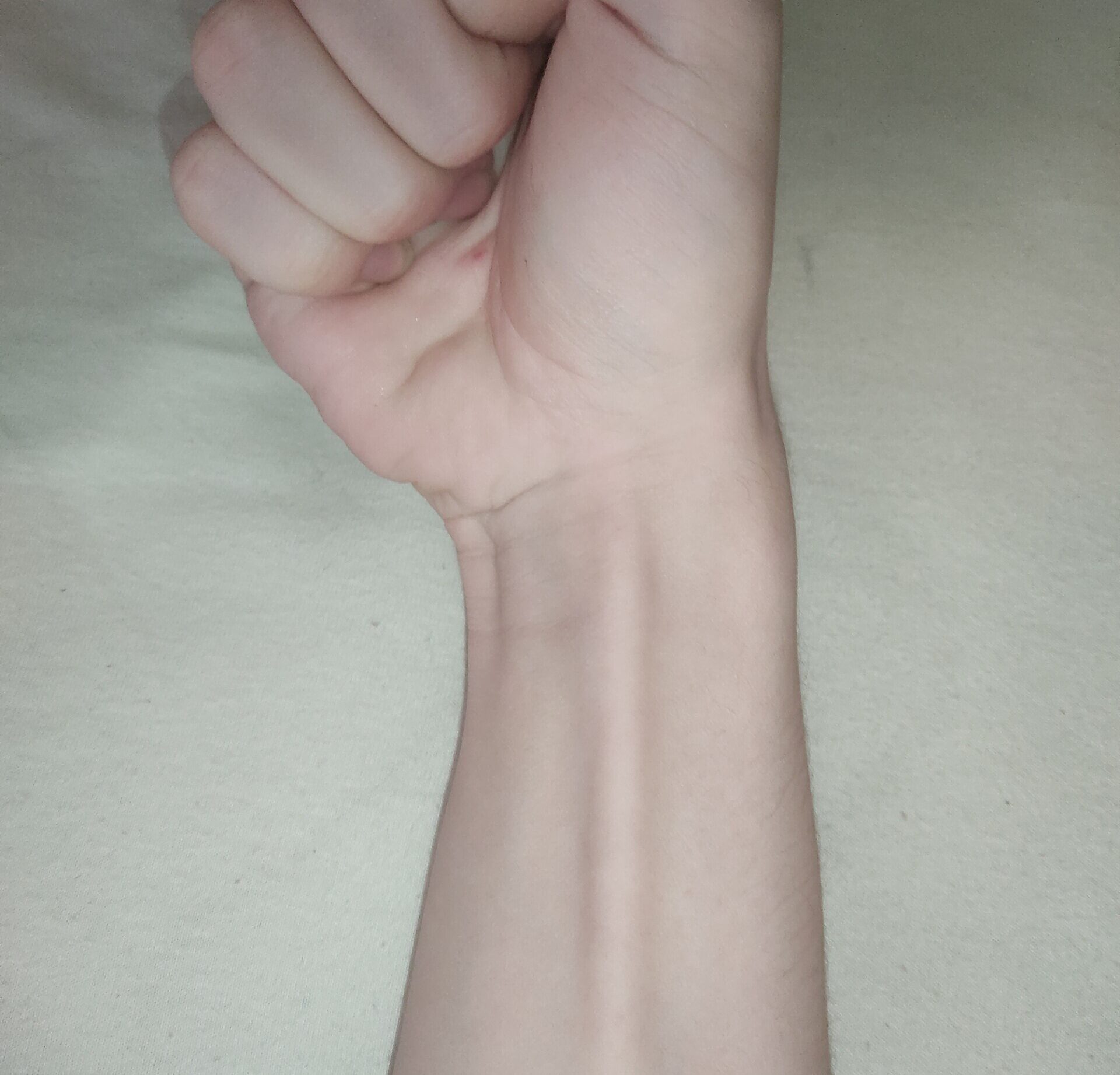The Palmaris Longus Tendon: Vanishing Muscle or Grip Booster?