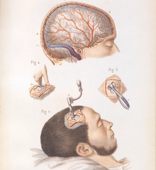 9 Ancient Medical Texts Describing Procedures That Were Dismissed as Fiction Until Archaeology Found the Instruments Used