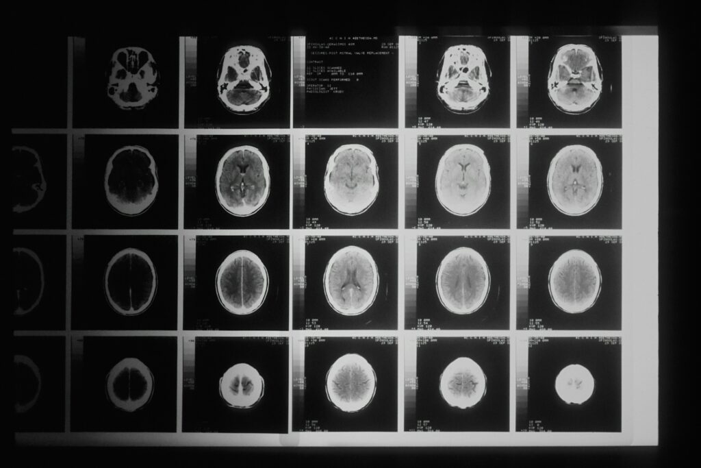 Researchers Have Discovered That the Brain Continues Generating Complex Coordinated Activity for Up to 30 Seconds After Clinical Death - and Nobody Agrees on What That Means